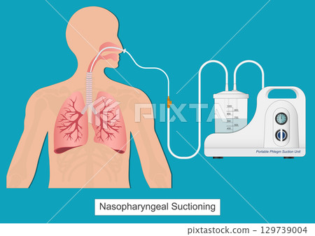 Nasogastric (NG) suctioning is the process 129739004