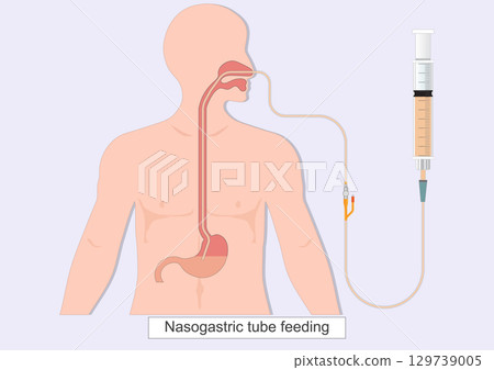 Nasogastric tube feeding (NG) is a thin flexible tube Nasogastric tube feeding (NG) is a thin flexible tube 129739005