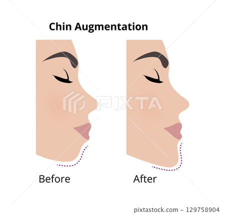 Woman face profile undergoing chin augmentation surgery 129758904