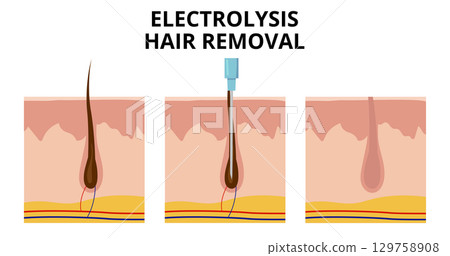 Electrolysis hair removal process showing probe inserting into hair follicle 129758908