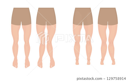 Genu valgum, varum and normal legs, front and back view comparison Genu valgum, varum and normal legs, front and back view comparison 129758914