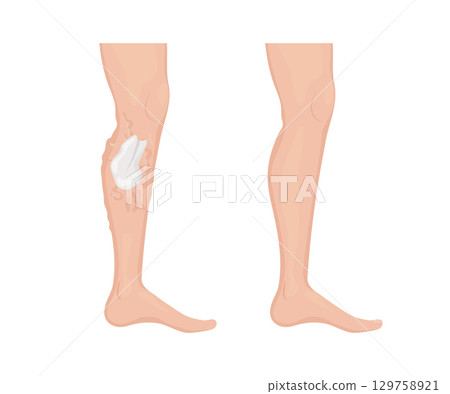 Applying varicose veins treatment cream showing before and after result 129758921