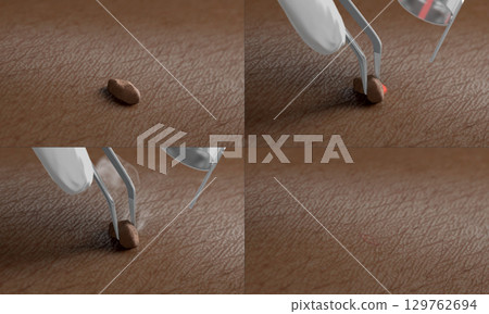 Skin surface with papilloma laser removal treatment process macro Skin surface with papilloma laser removal treatment process macro 129762694