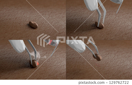 Skin surface with papilloma laser removal treatment process macro Skin surface with papilloma laser removal treatment process macro 129762722