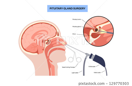 Pituitary gland surgery Pituitary gland surgery 129770303