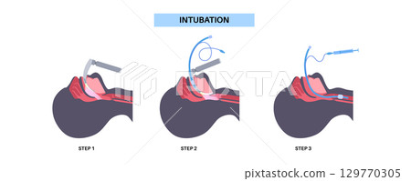 Intubation medical procedure 129770305