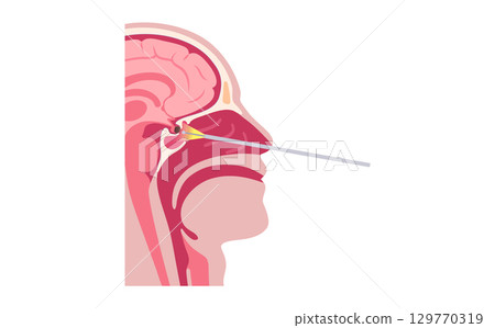 Pituitary gland surgery Pituitary gland surgery 129770319