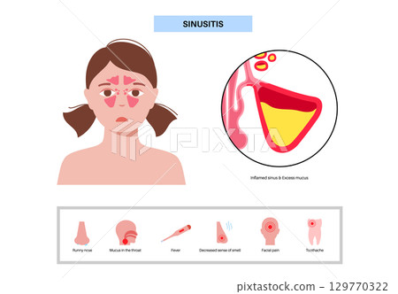 Sinusitis medical poster Sinusitis medical poster 129770322
