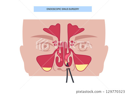 Nasal endoscopy poster Nasal endoscopy poster 129770323