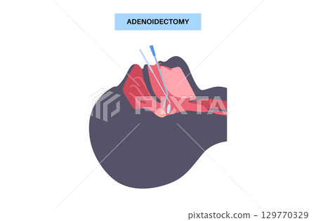 Adenoidectomy medical procedure 129770329