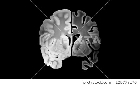 Alzheimer Left Hemisphere Brain Coronal Comparison Alzheimer Left Hemisphere Brain Coronal Comparison 129775176