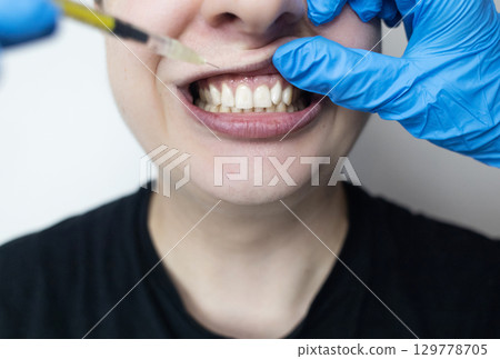 Dental injection for gum recession treatment. Exposure of tooth root and gum treatment. Regenerative therapy 129778705