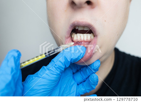Dental injection for gum recession treatment. Exposure of tooth root and gum treatment. Regenerative therapy 129778710