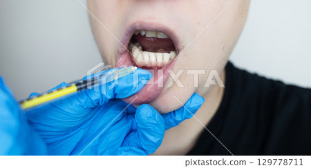 Dental injection for gum recession treatment. Exposure of tooth root and gum treatment. Regenerative therapy 129778711