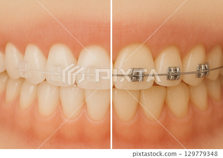 美容牙科、弓絲矯正、托槽 129779348