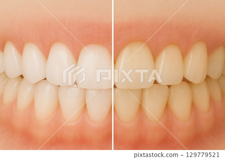 Whitening, cleaning, cosmetic dentistry 129779521