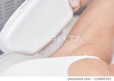 Laser hair removal treatment on female arm close-up 129800301
