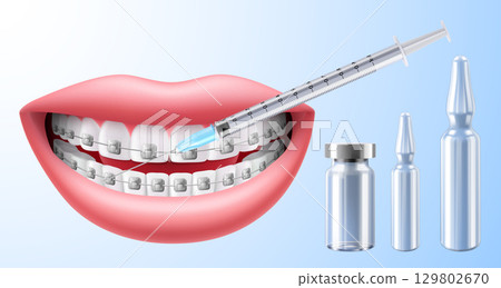 Female lips and injection syringe with Bottle for injection, Drug Ampoule, glass vial. lips augmentation procedure with hyaluronic acid, botox or filler. Realistic 3d vector illustration Female lips and injection syringe with Bottle for injection, Drug Ampoule, glass vial. lips augmentation procedure with hyaluronic acid, botox or filler. Realistic 3d vector illustration 129802670