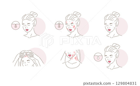 Beauty Girl Have Acne on her Face, Neck and Hair Skin. Blackheads, Whiteheads, Post Acne and other Acne Skin Problems Beauty Girl Have Acne on her Face, Neck and Hair Skin. Blackheads, Whiteheads, Post Acne and other Acne Skin Problems 129804831