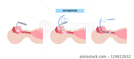 Intubation medical procedure 129812632