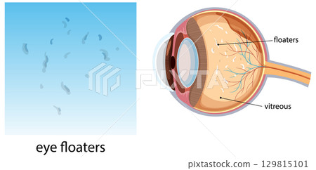 Medical Diagram of Eye Floaters and Vitreous Anatomy Medical Diagram of Eye Floaters and Vitreous Anatomy 129815101
