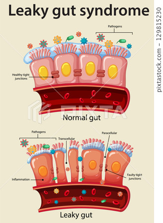 Comparison of Normal Gut and Leaky Gut Syndrome 129815230
