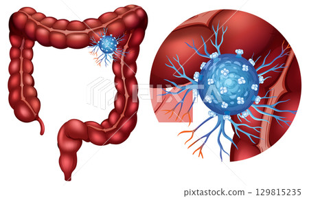 Detailed Colon Anatomy with Cancer Cell Illustration Detailed Colon Anatomy with Cancer Cell Illustration 129815235