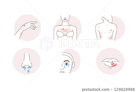 Beauty Girl Have Acne on her Face, Neck and Hair Skin. Blackheads, Whiteheads, Post Acne and other Acne Skin Problems Beauty Girl Have Acne on her Face, Neck and Hair Skin. Blackheads, Whiteheads, Post Acne and other Acne Skin Problems 129828998