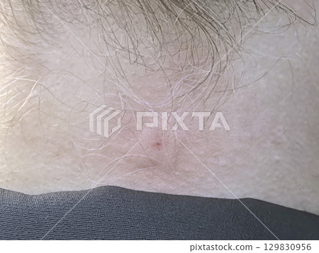 Wasp sting on neck leads to unusual tumor-like reaction Wasp sting on neck leads to unusual tumor-like reaction 129830956
