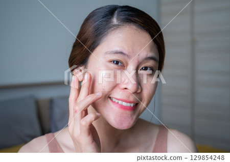 Asian woman smiling while applying acne cream on her face for treating acne and redness skin. Acne creams are topical treatments designed to combat acne by reducing inflammation. Asian woman smiling while applying acne cream on her face for treating acne and redness skin. Acne creams are topical treatments designed to combat acne by reducing inflammation. 129854248