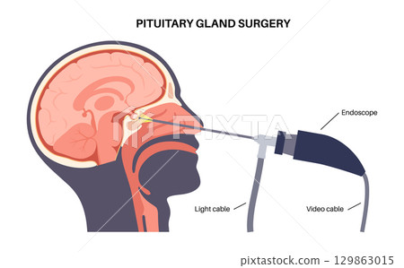 Pituitary gland surgery 129863015