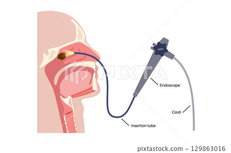 Nasal tumor surgery 129863016
