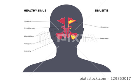 Sinusitis medical poster 129863017