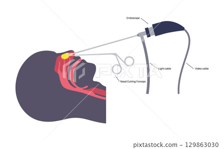 Nasal tumor surgery 129863030
