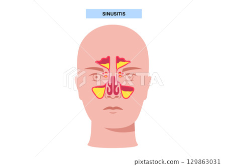 Sinusitis medical poster 129863031