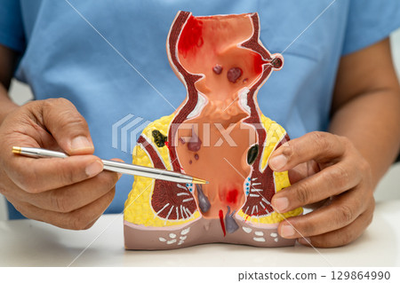 Asian doctor with rectum and hemorrhoid human anatomy model at hospital, inflamed vascular structure. 129864990