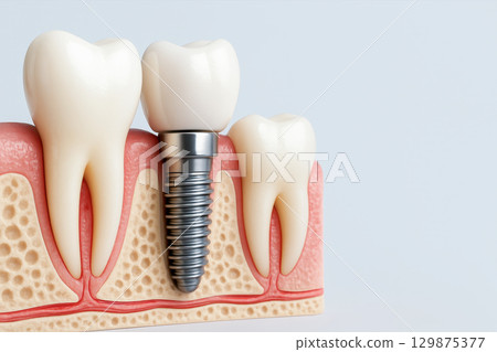 Dental implant illustration showing tooth replacement with metal screw in jawbone for dental care and oral health to prevent tooth decay in dental clinic environment 129875377