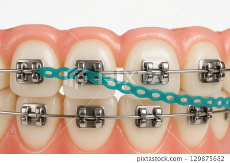 Dental braces with orthodontic treatment help improve teeth alignment and promote dental care for healthy smile and confident appearance in oral health management 129875682