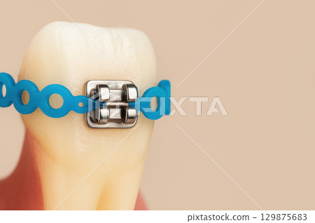 Dental braces with blue orthodontic treatment device on tooth model showing teeth alignment and dental care concept for healthy smile and oral hygiene 129875683