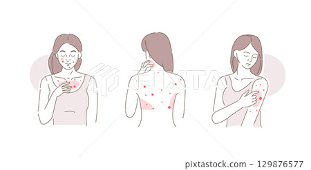 Beauty Girl Have Allergy and Acne Skin Problems. Woman Scratching her Body and Face with Hand. Allergic Dermatitis, Eczema or Nettle Rash with Itch Symptoms 129876577