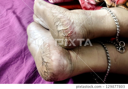 Close-Up of Cracked Heels and Bare Feet Close-Up of Cracked Heels and Bare Feet 129877803
