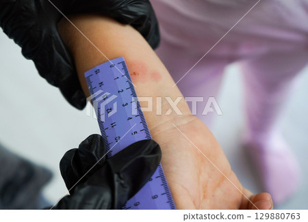 Closeup view photography of child's hand with red spot reaction to conducting Mantoux test after 72 hours from injection. Nurse in blue gloves applying transparent ruler to check reaction. 129880763