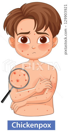 Sad Child With Chickenpox Rash and Magnifying Glass 129903921