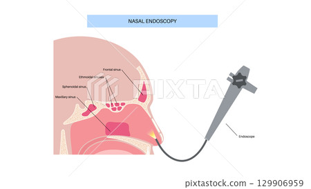 Nasal endoscopy poster 129906959