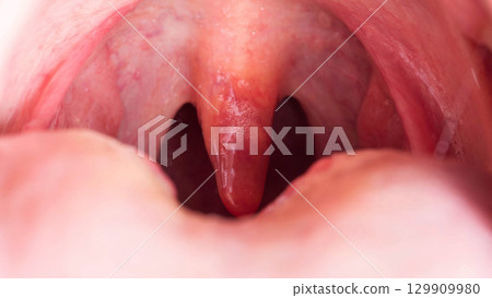 Uvulitis and sore throat in the oral cavity due to illness. Inflammation of the uvula and tonsils due to infections during illness, close-up, streptococcus. Allergy 129909980