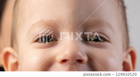 Little boy with pus in his eyes, the boy's disease is bacterial conjunctivitis. Viral infection in the eyes, close-up Little boy with pus in his eyes, the boy's disease is bacterial conjunctivitis. Viral infection in the eyes, close-up 129910520