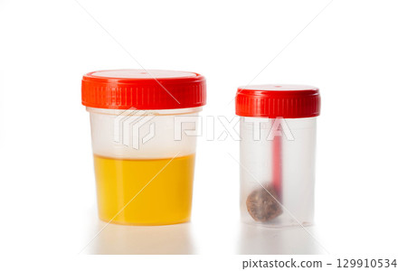 Urine and feces analysis on a white background, isolate. Examination of urine and feces for infections, close-up Urine and feces analysis on a white background, isolate. Examination of urine and feces for infections, close-up 129910534