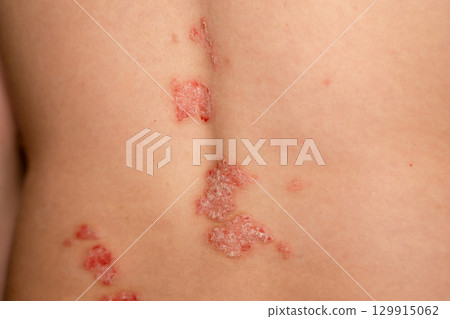 Psoriasis skin patches on a persons back showing red, itchy, and scaly spots indicative of this genetic immune disease Psoriasis skin patches on a persons back showing red, itchy, and scaly spots indicative of this genetic immune disease 129915062