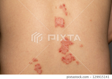 Psoriasis patches on skin highlighting symptoms of a chronic immune disease Psoriasis patches on skin highlighting symptoms of a chronic immune disease 129915141