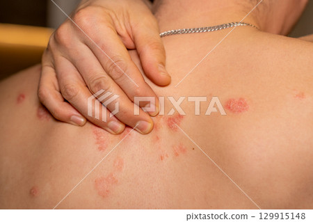 Psoriasis manifests as itchy, scaly patches on the skin, affecting individuals with this genetic immune disease Psoriasis manifests as itchy, scaly patches on the skin, affecting individuals with this genetic immune disease 129915148